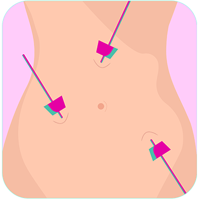 Laparoscopy